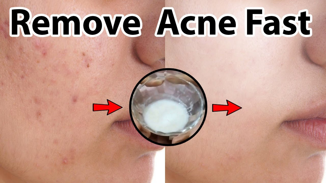 Diy Acne Scar Removal Best Of Home Remedy How to Remove Acne Scars From Face Diy