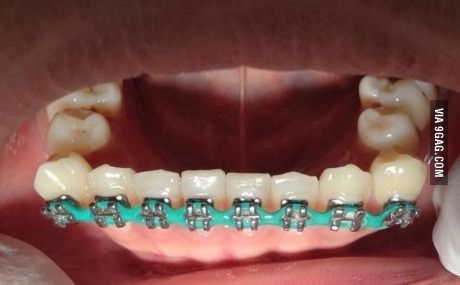 Diy Braces Gone Wrong New Homemade Braces Gone Wrong Latasha Schafer